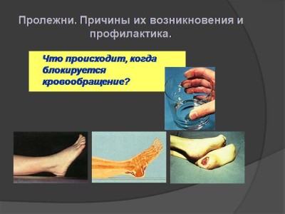 Мази и препараты для лечения пролежней у лежачих больных