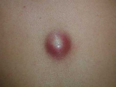 Отличия от других подкожных опухолей Отличия от других подкожных опухолей