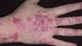 Причины появления и лечение красных пятен на руках