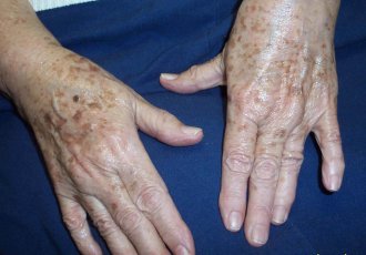 Причины и лечение пигментных пятен на руках после 50 лет